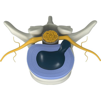 Computerized Disc Rehydration is applied to the spine