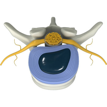 Computerized Disc Rehydration stretches the spine